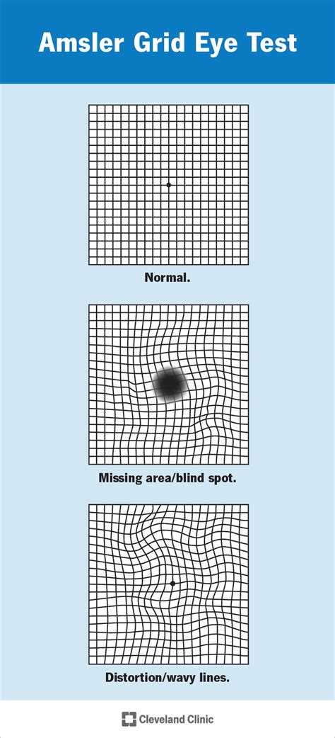 Amsler Grid Eye Test: What It Is, Types & Uses .